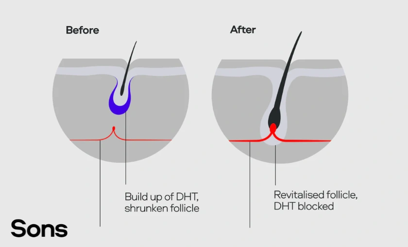 Sons UK Review: Best Solution for Hair Loss & Men’s Health! ([wpsm_custom_meta type=date field=month] [wpsm_custom_meta type=date field=year]) - The Complete Portal