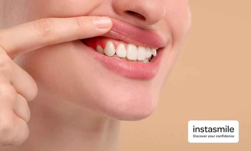 Instasmile US Review: Best Cosmetic Clip-On Veneers! ([wpsm_custom_meta type=date field=month] [wpsm_custom_meta type=date field=year]) - The Complete Portal