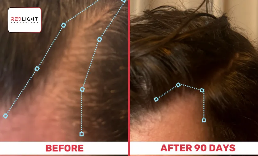 RedLight Innovation Review: Best Hair Growth Hats! ([wpsm_custom_meta type=date field=month] [wpsm_custom_meta type=date field=year]) - The Complete Portal
